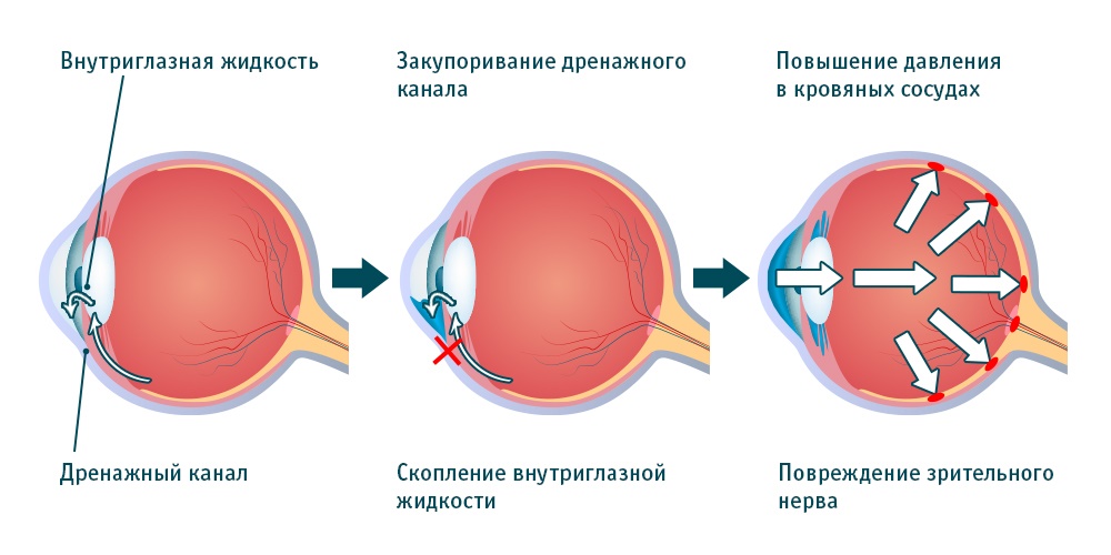 Глаукома вероятность появления с возрастом thumbnail